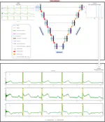 Real‑time ECG Signal detection using DL on edge devices (with Epsidy)